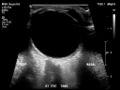 Normal eye ultrasound (Radiopaedia 70415-80514 A 6).jpg