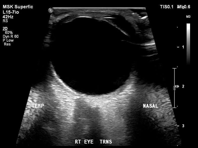 File:Normal eye ultrasound (Radiopaedia 70415-80514 A 6).jpg