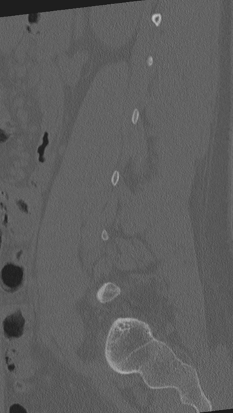 File:Normal lumbar spine CT (Radiopaedia 46533-50986 Sagittal bone window 29).png