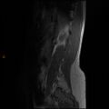 Normal spine MRI (Radiopaedia 77323-89408 Sagittal T1 2).jpg