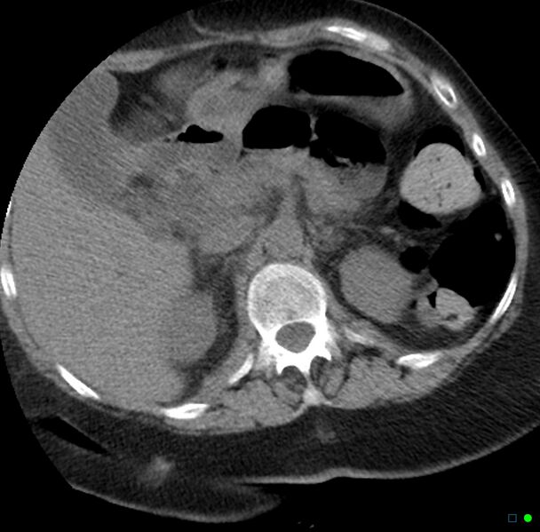 File:Obstructed infected horseshoe kidney (Radiopaedia 18116-17898 non-contrast 1).jpg