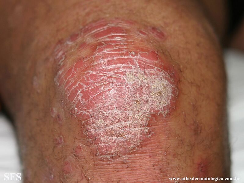 File:Psoriasis (Dermatology Atlas 131).jpg