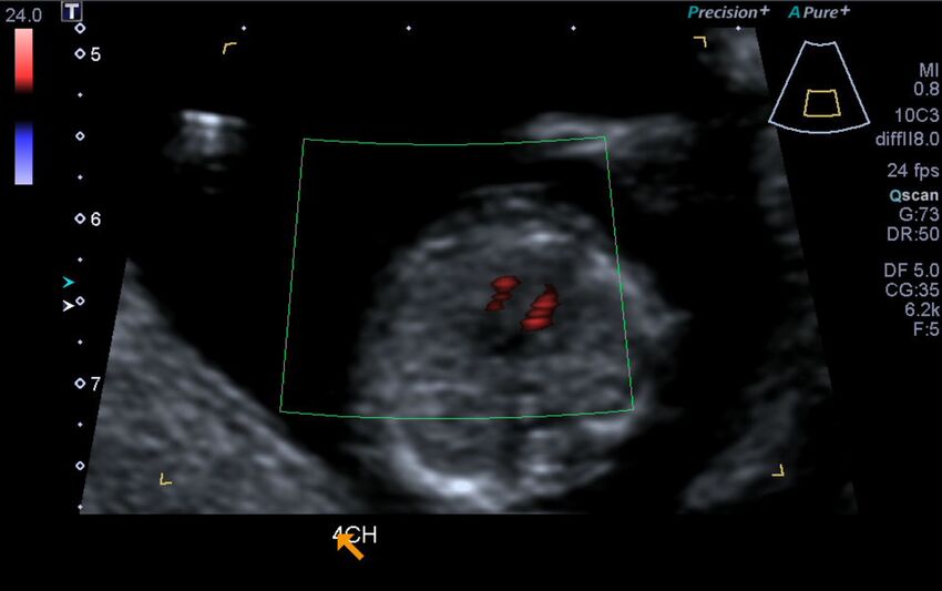 1st trimester nuchal-morphology ultrasound (Radiopaedia 44706-48477 Heart views cine with colour 81).jpg