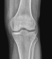 ACL avulsion and Segond fracture (Radiopaedia 81283).PNG
