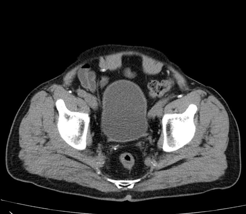 Abdominal aortic aneurysm (Radiopaedia 22421-22458 non-contrast 50).jpg