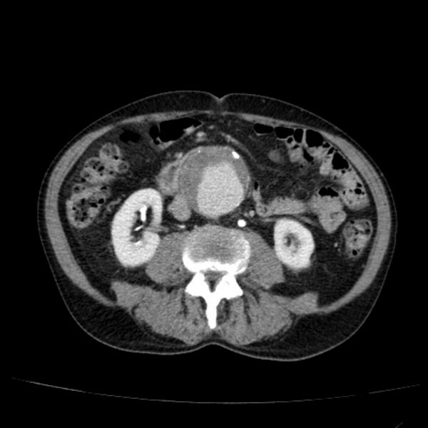 File:Abdominal aortic aneurysm (Radiopaedia 29248-29660 Axial C+ portal venous phase 32).jpg