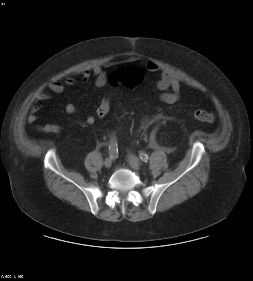 Abdominal aortic aneurysm with intramural hematoma then rupture (Radiopaedia 50278-55631 Axial non-contrast 95).jpg