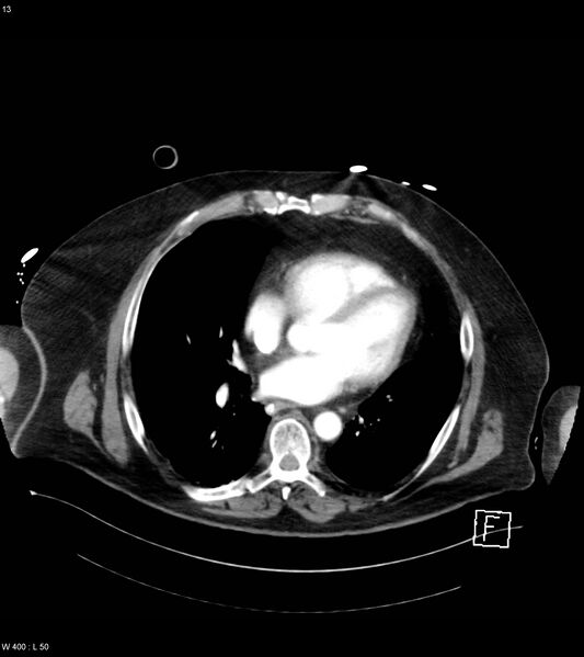 File:Abdominal aortic aneurysm with intramural hematoma then rupture (Radiopaedia 50278-55632 Axial C+ arterial phase 12).jpg