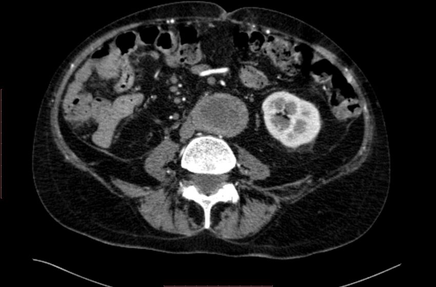 Abdominal aortic interposition tube graft and aneurysm thrombosis (Radiopaedia 71438-81857 Axial C+ arterial phase 104).jpg