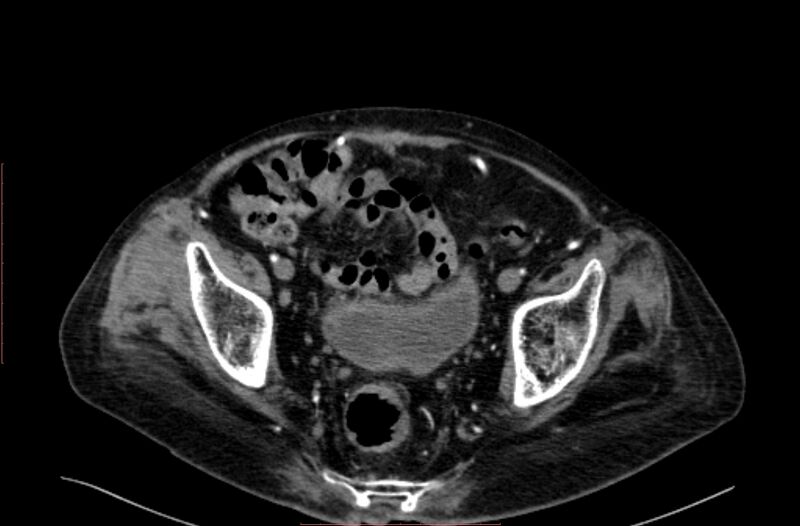 File:Abdominal aortic interposition tube graft and aneurysm thrombosis (Radiopaedia 71438-81857 Axial C+ arterial phase 204).jpg