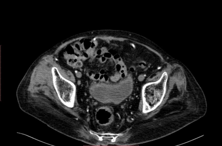 Abdominal aortic interposition tube graft and aneurysm thrombosis (Radiopaedia 71438-81857 Axial C+ arterial phase 204).jpg