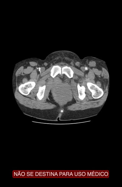 File:Abdominal desmoid tumor (Radiopaedia 44024-47540 Axial C+ arterial phase 56).jpg