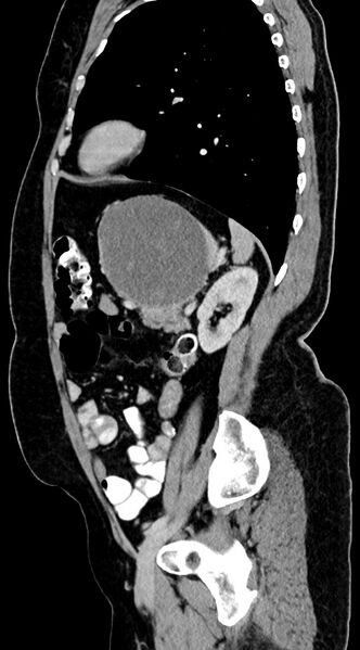 File:Abdominal hydatid disease (Radiopaedia 68223-77737 Sagittal C+ portal venous phase 21).jpg