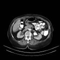 Abdominal wall recurrence after colorectal resection for cancer (Radiopaedia 23444-23523 Axial C+ portal venous phase 10).jpg