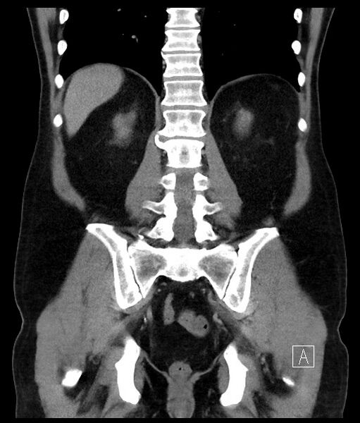 File:Acute-on-chronic pancreatitis (Radiopaedia 67286-76656 Coronal C+ portal venous phase 55).jpg