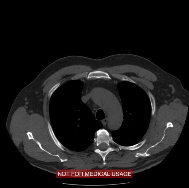 File:Acute aortic dissection - Stanford type A (Radiopaedia 40661-43285 Axial non-contrast 3).jpg