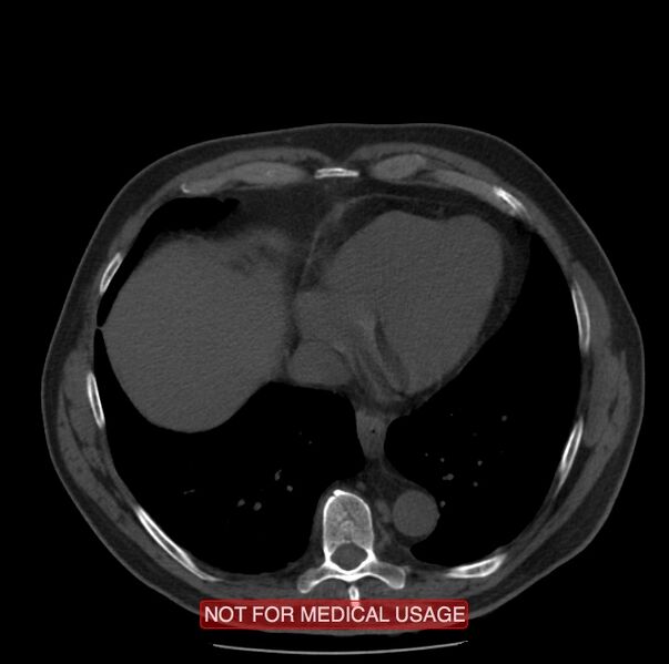 File:Acute aortic dissection - Stanford type A (Radiopaedia 40661-43285 Axial non-contrast 51).jpg