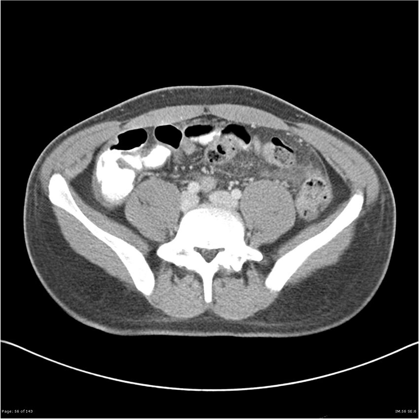 Acute appendicitis (Radiopaedia 25364-25615 B 46).jpg