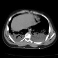 Acute aspiration pneumonitis (Radiopaedia 33605-34703 Axial non-contrast 65).jpg