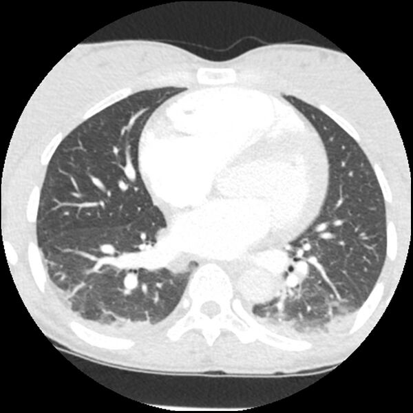 File:Acute chest syndrome - sickle cell disease (Radiopaedia 42375-45499 Axial lung window 112).jpg