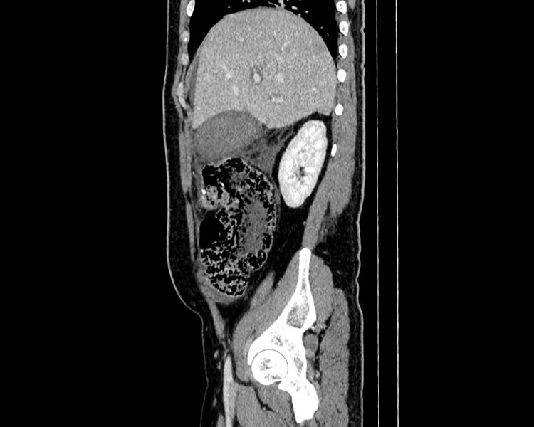 File:Acute cholecystitis (Radiopaedia 53216-59182 Sagittal C+ portal venous phase 5).jpg