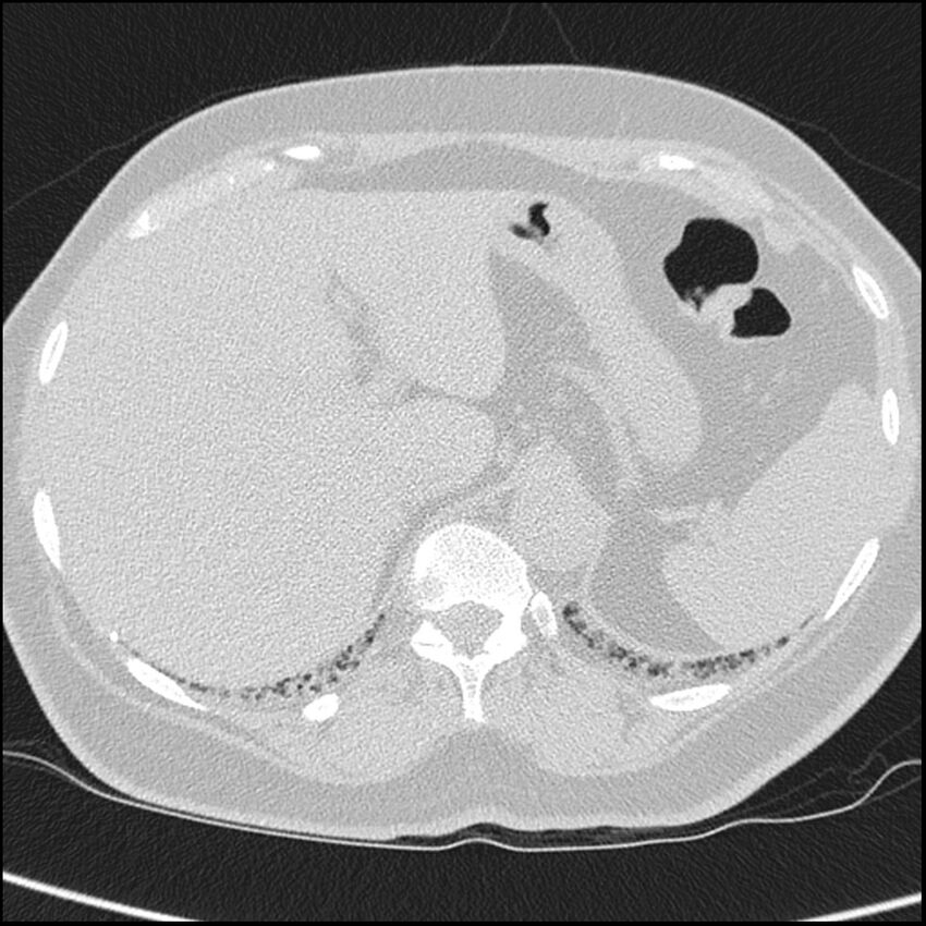 Acute interstitial pneumonitis (Radiopaedia 45404-49453 Axial lung window 75).jpg