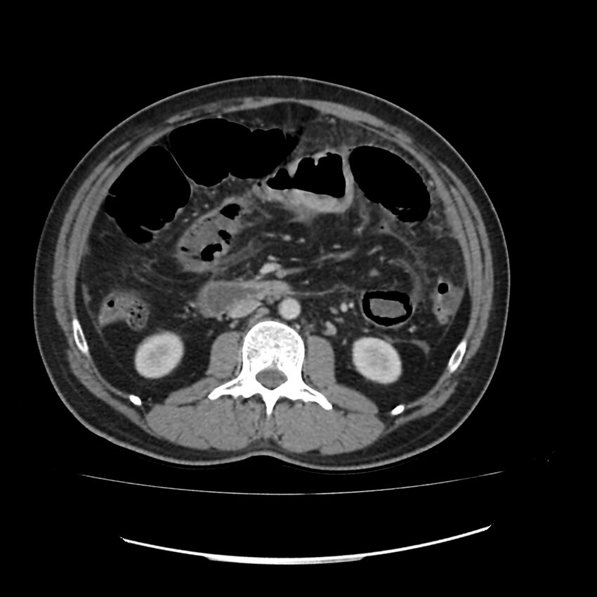 Acute mesenteric ischemia - superior mesenteric artery thrombosis (Radiopaedia 73947-84776 Axial C+ portal venous phase 61).jpg