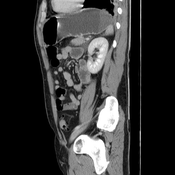 File:Acute pancreatitis (Radiopaedia 22572-22596 Sagittal C+ portal venous phase 38).jpg