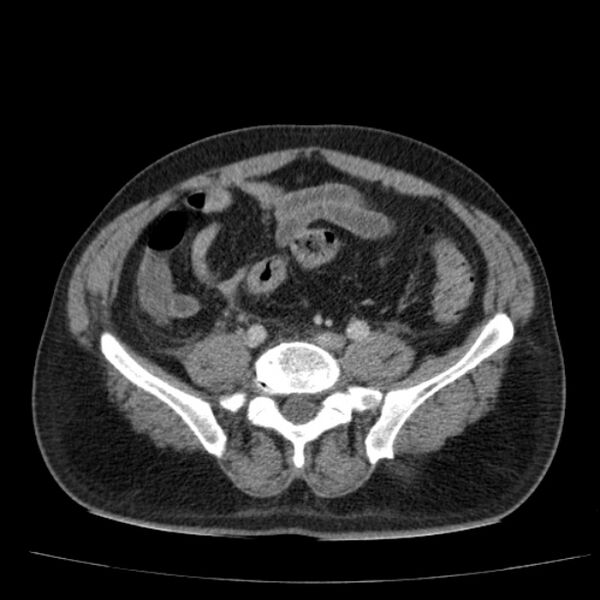 File:Acute pancreatitis (Radiopaedia 26663-26813 Axial C+ portal venous phase 61).jpg