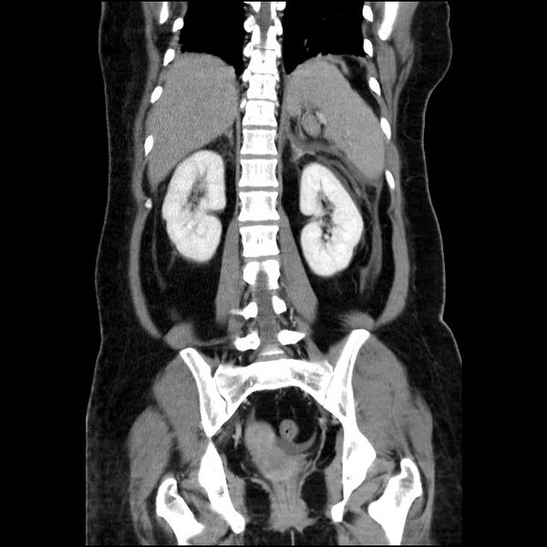 File:Acute pancreatitis (Radiopaedia 69236-79012 Coronal C+ portal venous phase 29).jpg