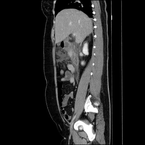 File:Acute pancreatitis (Radiopaedia 69236-79012 Sagittal C+ portal venous phase 65).jpg