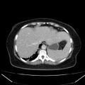 Acute pancreatitis - Balthazar C (Radiopaedia 26569-26714 Axial C+ portal venous phase 22).jpg