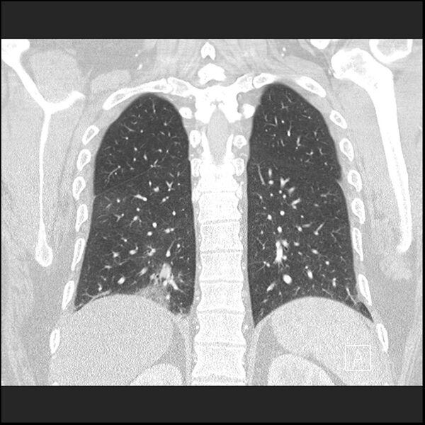 File:Acute pulmonary embolism with pulmonary infarct (Radiopaedia 73062-83768 Coronal lung window 57).jpg