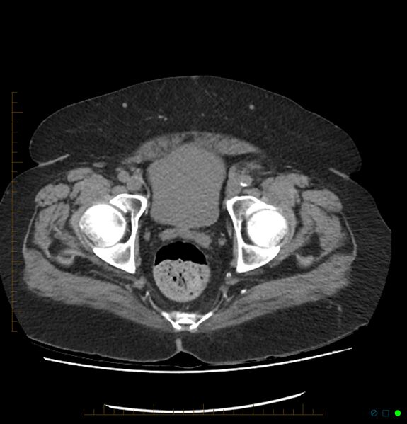 File:Acute renal failure post IV contrast injection- CT findings (Radiopaedia 47815-52557 Axial non-contrast 75).jpg