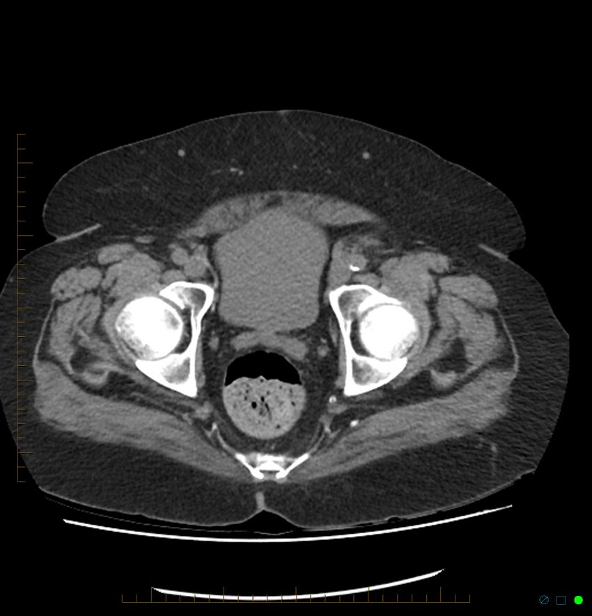 Acute renal failure post IV contrast injection- CT findings (Radiopaedia 47815-52557 Axial non-contrast 75).jpg