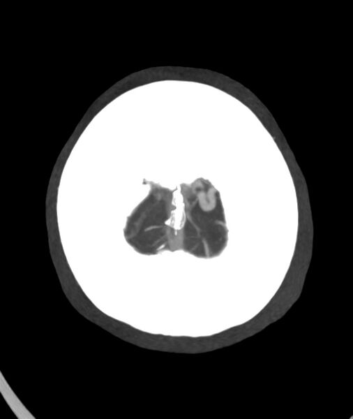 File:Acute right MCA M1 occlusion (Radiopaedia 62268-70454 Axial Phase 1 1).jpg