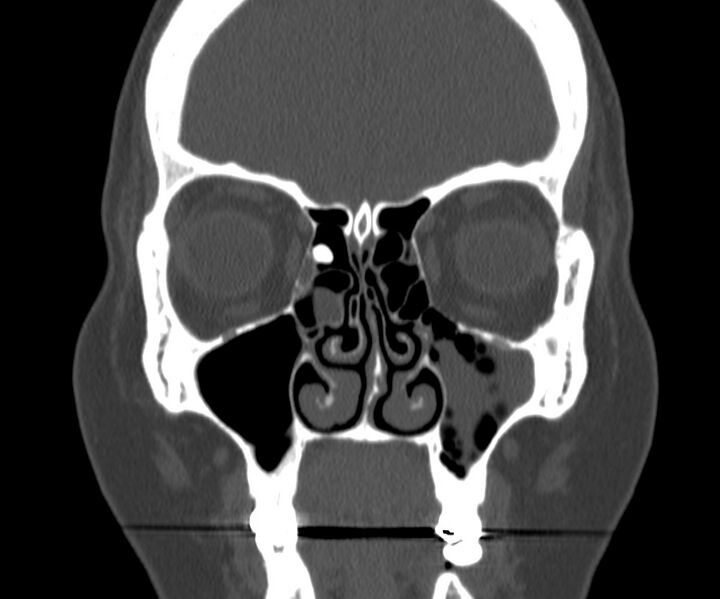 File:Acute sinusitis (Radiopaedia 22419-22455 Coronal bone window 15).jpg