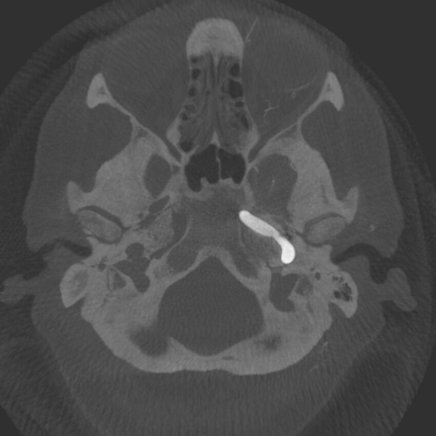 Acute subarachnoid hemorrhage and accessory anterior cerebral artery (Radiopaedia 69231-79010 C 7).jpg
