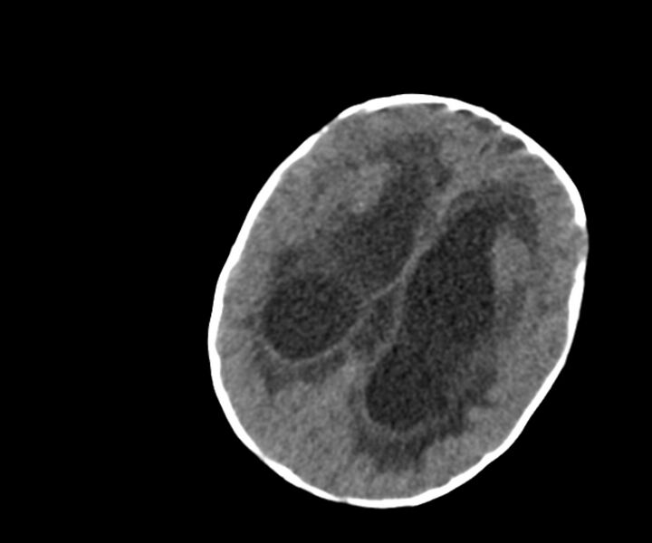 File:Acute ventriculitis (Radiopaedia 57502-64459 Axial non-contrast 11).jpg