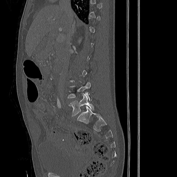 File:Acute vertebral body compression fractures (Radiopaedia 31757-32693 Sagittal bone window 37).jpg