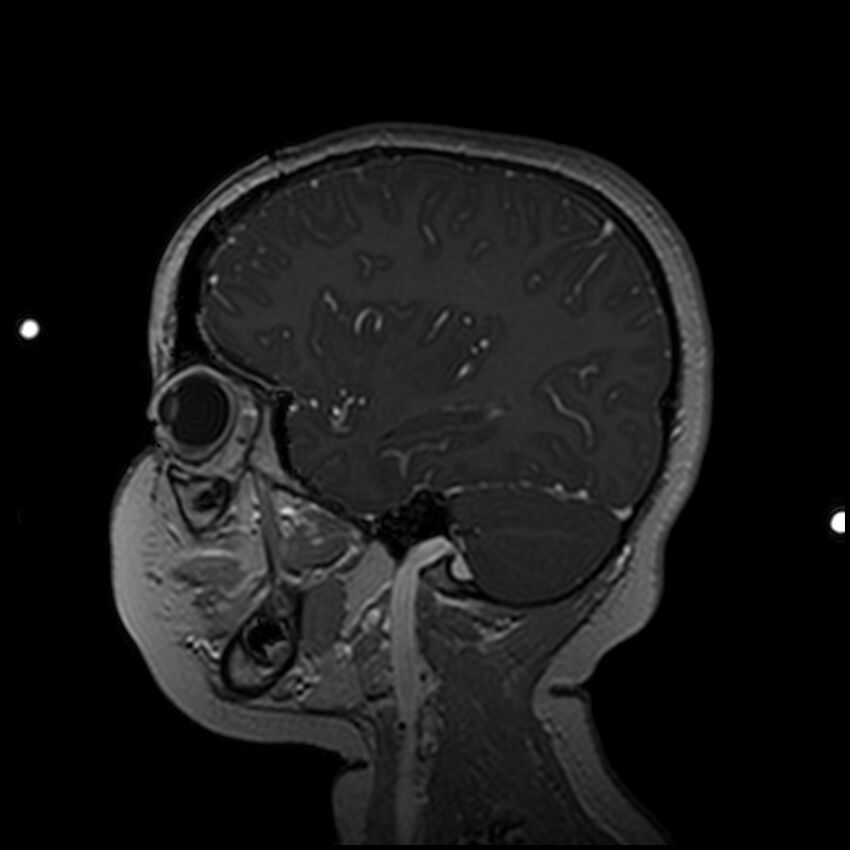 Adamantinomatous craniopharyngioma (Radiopaedia 77407-89529 H 88).jpg
