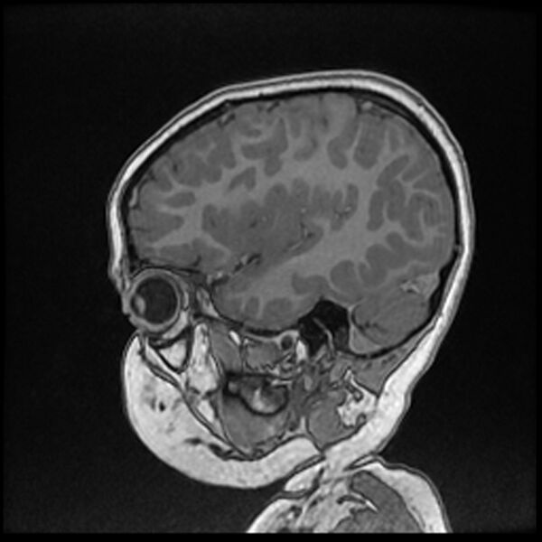 File:Adamantinomatous craniopharyngioma (Radiopaedia 77407-89529 Sagittal T1 C+ 33).jpg