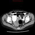 Adenocarcinoma of the colon (Radiopaedia 8191-9039 Axial liver window 67).jpg