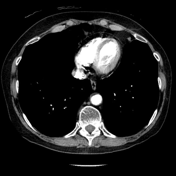 File:Adenocarcinoma of the lung (Radiopaedia 41015-43755 Axial C+ portal venous phase 91).jpg