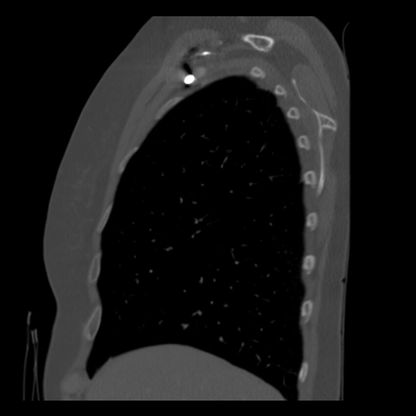 Adenocarcinoma of the lung (Radiopaedia 41015-43755 Sagittal bone window 16).jpg