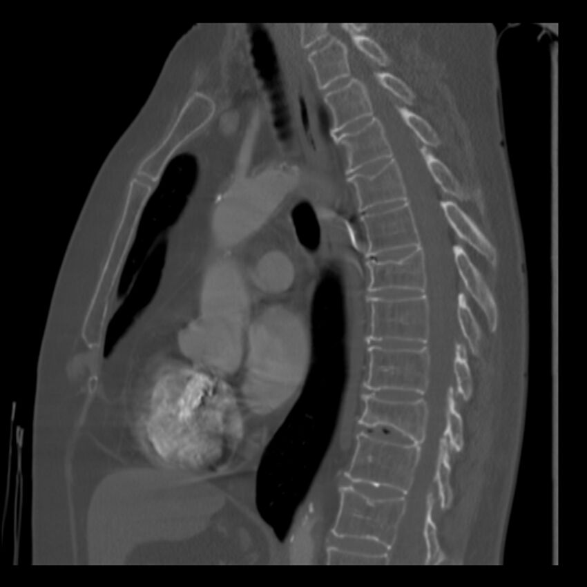 Adenocarcinoma of the lung (Radiopaedia 41015-43755 Sagittal bone window 54).jpg