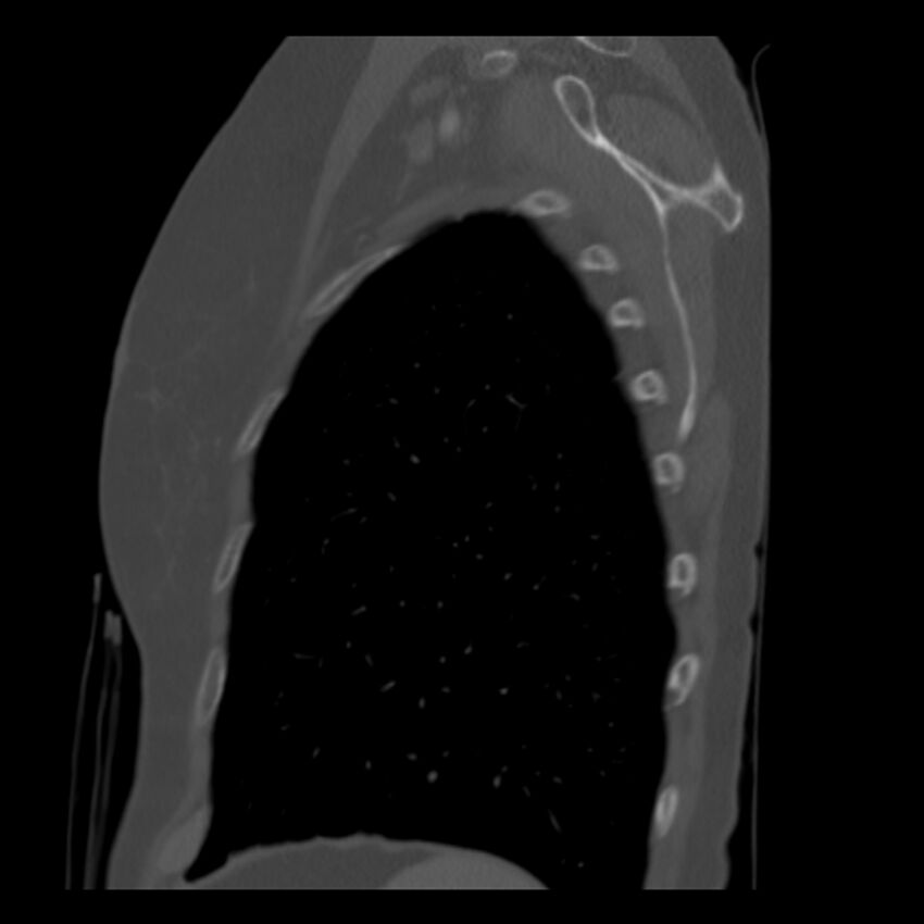 Adenocarcinoma of the lung (Radiopaedia 41015-43755 Sagittal bone window 95).jpg