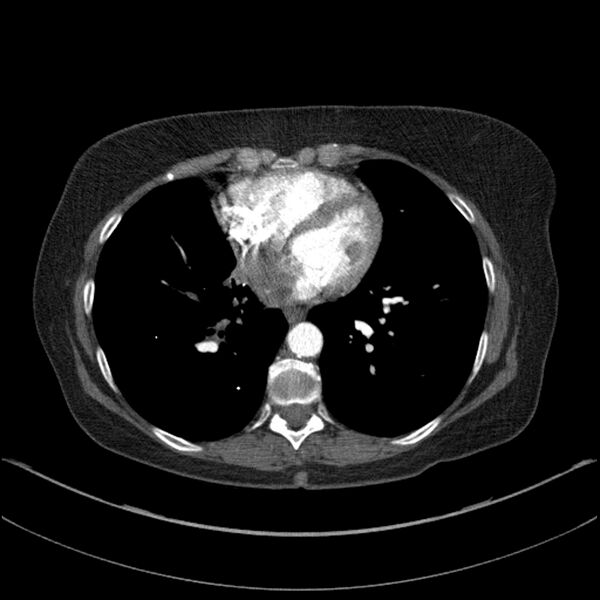 File:Adenocarcinoma of the lung (Radiopaedia 44205-47803 Axial C+ portal venous phase 56).jpg
