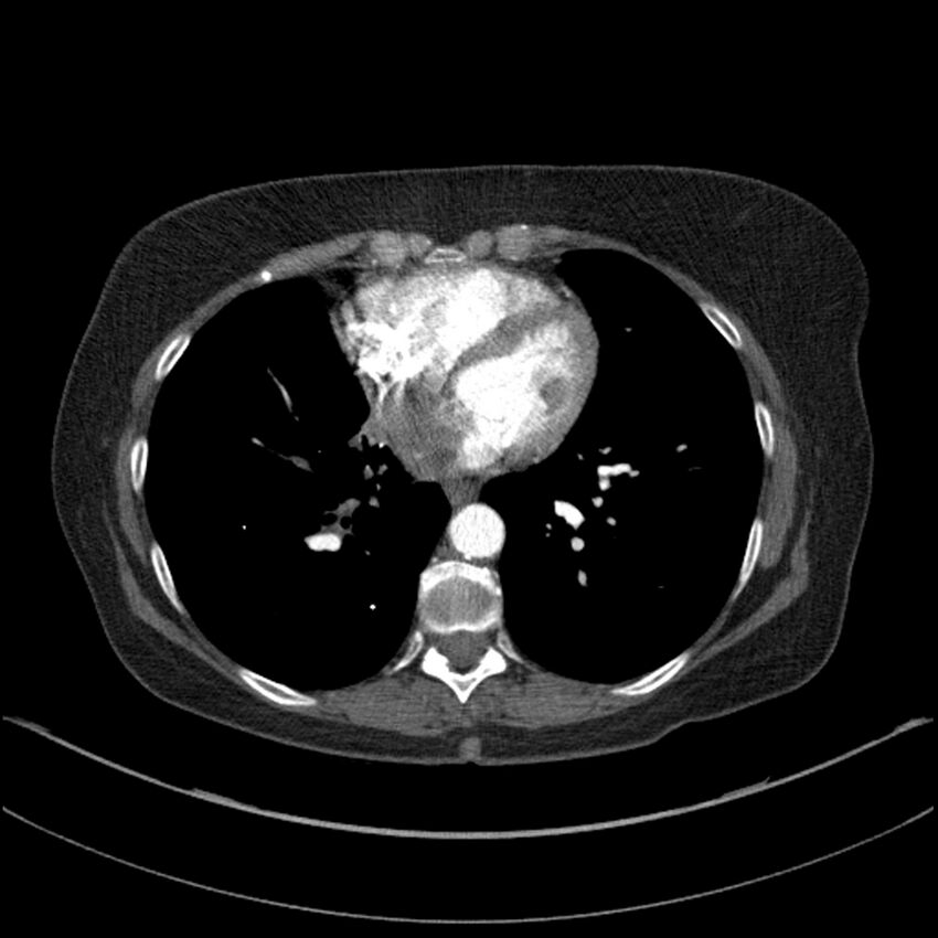 Adenocarcinoma of the lung (Radiopaedia 44205-47803 Axial C+ portal venous phase 56).jpg