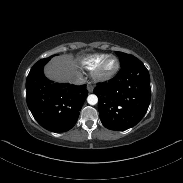 File:Adenocarcinoma of the lung (Radiopaedia 44205-47803 Axial C+ portal venous phase 65).jpg